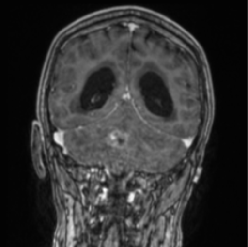 Cerebellar metastasis from lung adenocarcinoma (Radiopaedia 86690-102829 Coronal T1 C+ 35).png