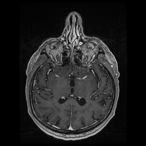 Cerebellar metastasis of pulmonary adenocarcinoma, cavernous venous malformation, and developmental venous anomaly (Radiopaedia 85827-101661 Axial T1 C+ 53).jpg