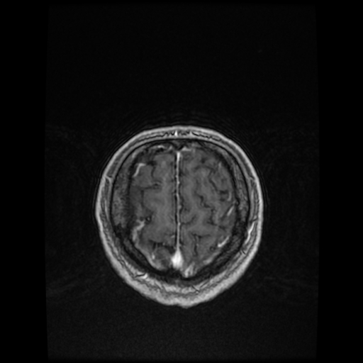 Cerebellar metastasis of pulmonary adenocarcinoma, cavernous venous malformation, and developmental venous anomaly (Radiopaedia 85827-101661 Axial T1 C+ 81).jpg