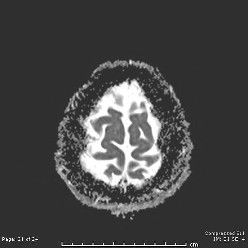 File:Cerebellar strokes due to intracranial giant cell arteritis (Radiopaedia 68799-81713 Axial ADC 21).jpg