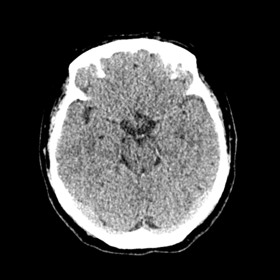 File:Cerebellopontine angle meningioma (Radiopaedia 53561-59592 Axial non-contrast 25).jpg