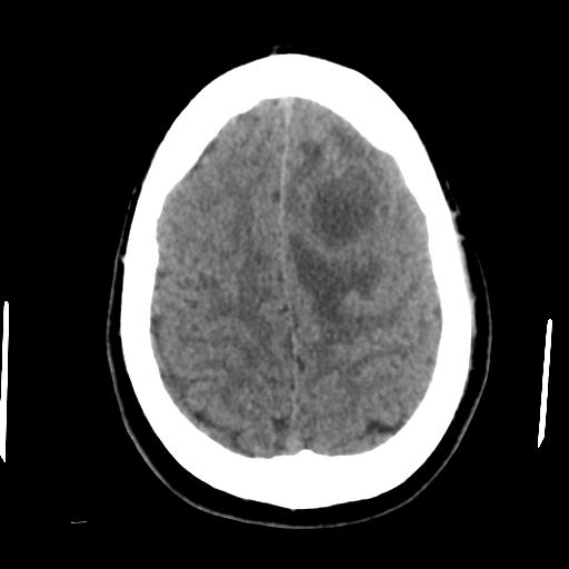 Cerebral abscess (Radiopaedia 29451-29919 Axial non-contrast 40).jpg