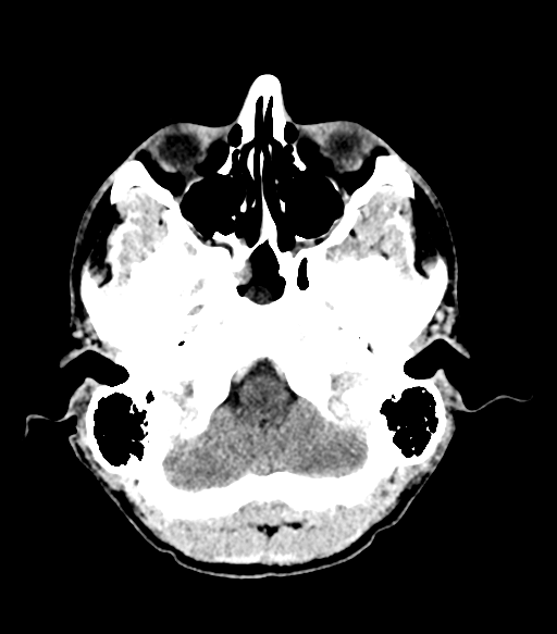 Cerebral abscess (Radiopaedia 57774-64741 Axial C+ delayed 18).png