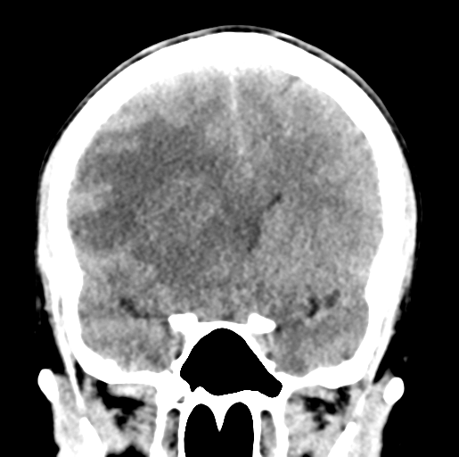 File:Cerebral abscess (Radiopaedia 60342-68008 Coronal non-contrast 24).png