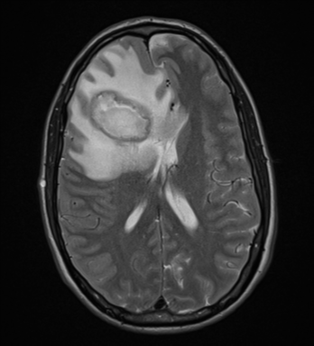 File:Cerebral abscess (Radiopaedia 60342-68009 Axial T2 21).png