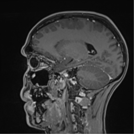 Cerebral abscess (Radiopaedia 60342-68009 J 23).png