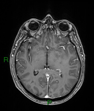 Cerebral abscess and subdural empyema (Radiopaedia 84436-99779 Axial T1 C+ 46).jpg