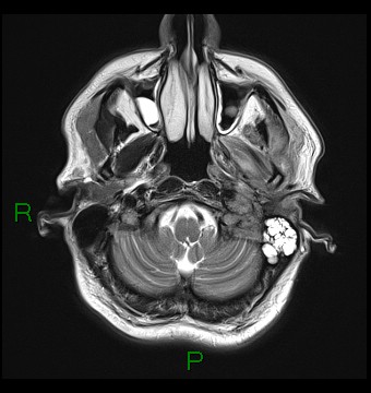 File:Cerebral abscess and subdural empyema (Radiopaedia 84436-99779 Axial T2 3).jpg