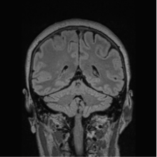 Cerebral abscess from pulmonary arteriovenous malformation (Radiopaedia 86275-102291 Coronal FLAIR 33).png