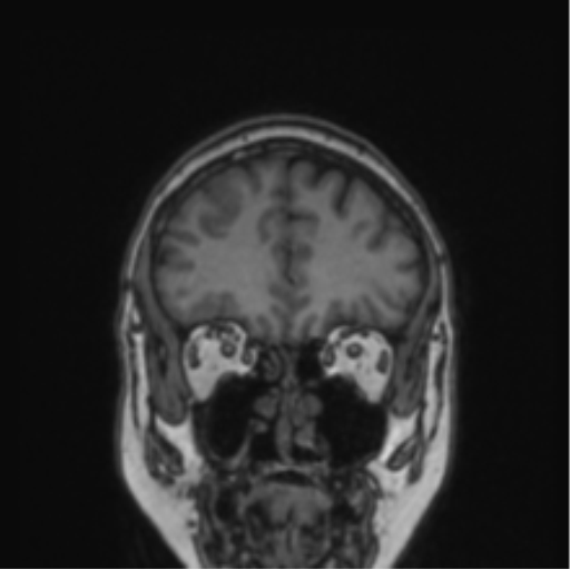 File:Cerebral abscess from pulmonary arteriovenous malformation (Radiopaedia 86275-102291 Coronal T1 70).png