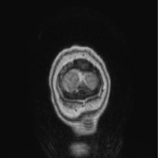 Cerebral abscess from pulmonary arteriovenous malformation (Radiopaedia 86275-102291 L 6).png