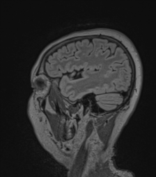 Cerebral abscess from pulmonary arteriovenous malformation (Radiopaedia 86275-102291 Sagittal FLAIR 17).png