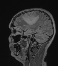 Cerebral abscess from pulmonary arteriovenous malformation (Radiopaedia 86275-102291 Sagittal FLAIR 49).png