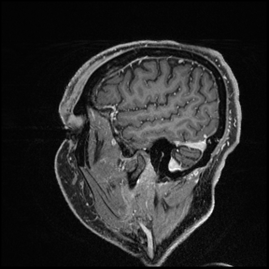 Cerebral abscess with ventriculitis (Radiopaedia 78965-91878 Sagittal T1 C+ 37).jpg