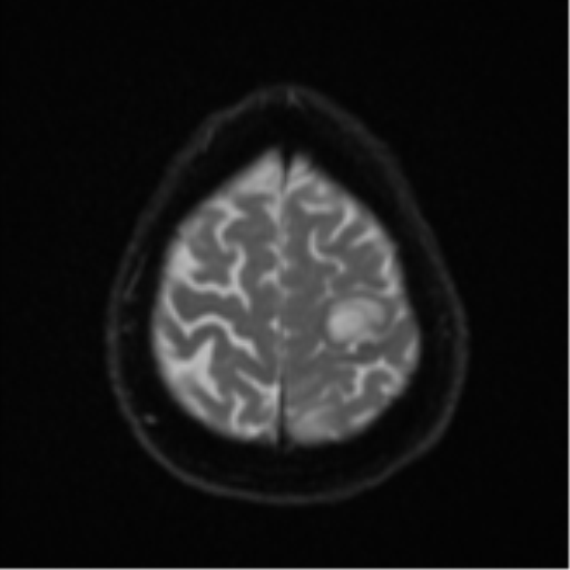 Cerebral abscesses- medically managed (Radiopaedia 45183-49179 Axial DWI 24).png