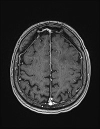 Cerebral amyloid angiopathy-related inflammation (Radiopaedia 58270-65377 Axial T1 C+ fat sat 111).jpg