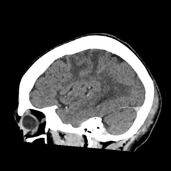 Cerebral amyloid angiopathy-related inflammation (Radiopaedia 74836-85848 C 45).jpg