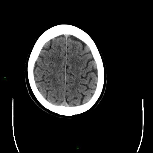 Cerebral amyloid angiopathy (Radiopaedia 77506-89665 Axial non-contrast 89).jpg