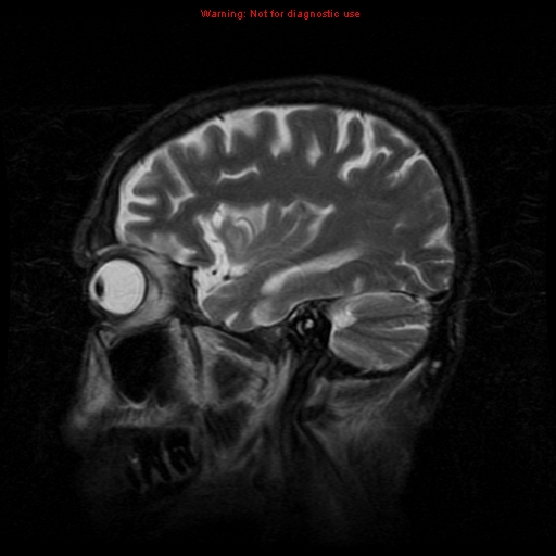 File:Cerebral and orbital tuberculomas (Radiopaedia 13308-13311 Sagittal T2 15).jpg