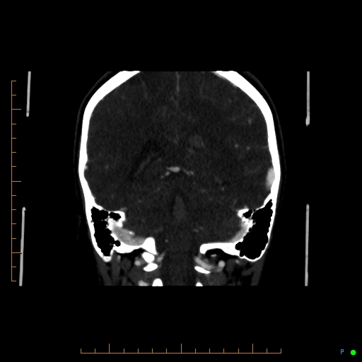 Cerebral arteriovenous malformation (AVM) (Radiopaedia 78162-90706 Coronal CTA 39).jpg