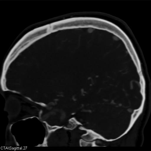 Cerebral arteriovenous malformation (Radiopaedia 28518-28759 D 24).jpg