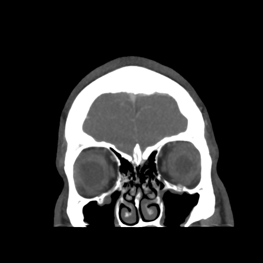 Cerebral arteriovenous malformation (Radiopaedia 39259-41505 E 9).png