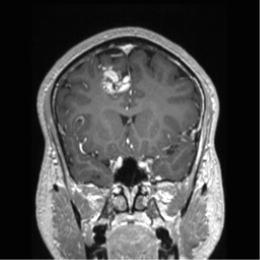 Cerebral arteriovenous malformation (Radiopaedia 39259-41506 Coronal T1 C+ 62).png
