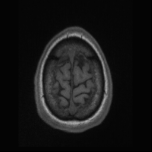 Cerebral arteriovenous malformation (Radiopaedia 55798-62372 Axial T1 66).png