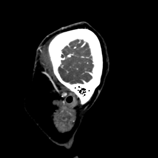 Cerebral arteriovenous malformation (Radiopaedia 73830-84645 Sagittal C+ delayed 85).jpg