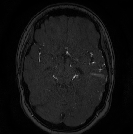 Cerebral arteriovenous malformation (Radiopaedia 74411-85654 Axial MRA 53).jpg