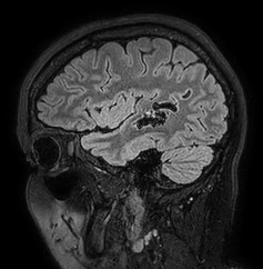 Cerebral arteriovenous malformation (Radiopaedia 74411-85654 Sagittal FLAIR 28).jpg