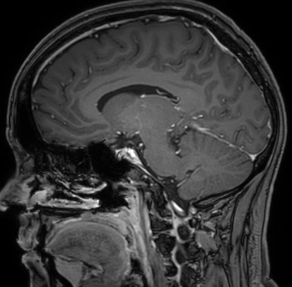 Cerebral arteriovenous malformation (Radiopaedia 74411-85654 Sagittal T1 C+ 58).jpg