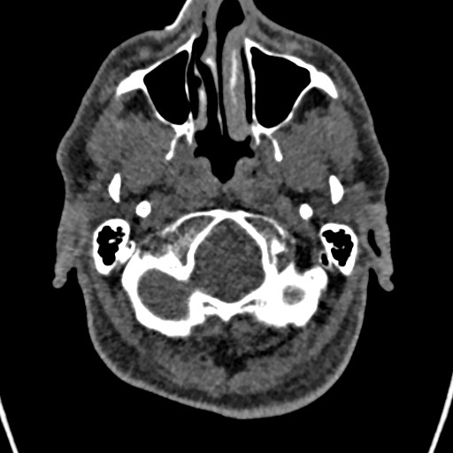 Cerebral arteriovenous malformation (Radiopaedia 78188-90746 Axial non-contrast 16).jpg