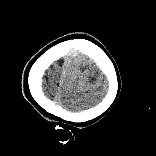 Cerebral arteriovenous malformation (Radiopaedia 79677-92887 Axial non-contrast 58).jpg