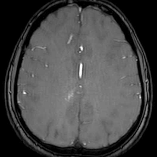 Cerebral arteriovenous malformation at posterior body of corpus callosum (Radiopaedia 74111-84925 Axial MRA 152).jpg