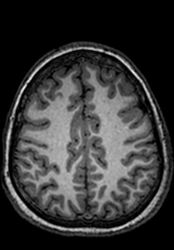 File:Cerebral arteriovenous malformation at posterior body of corpus callosum (Radiopaedia 74111-84925 Axial T1 71).jpg