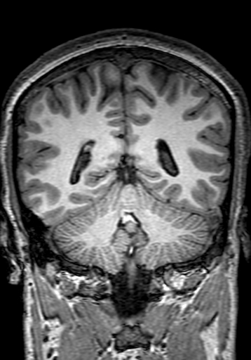 File:Cerebral arteriovenous malformation at posterior body of corpus callosum (Radiopaedia 74111-84925 Coronal T1 235).jpg
