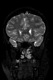 Cerebral arteriovenous malformation at posterior body of corpus callosum (Radiopaedia 74111-84925 Coronal T2 49).jpg