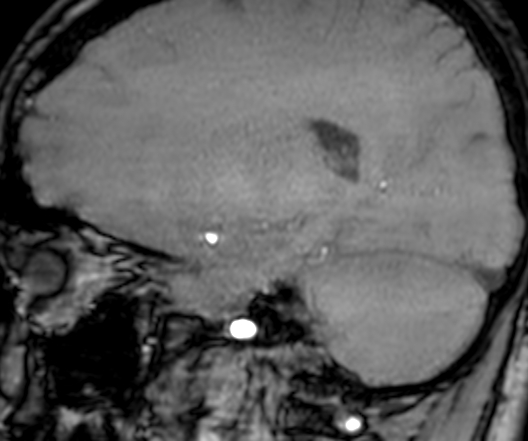Cerebral arteriovenous malformation at posterior body of corpus callosum (Radiopaedia 74111-84925 J 258).jpg