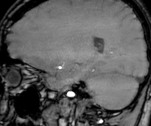 Cerebral arteriovenous malformation at posterior body of corpus callosum (Radiopaedia 74111-84925 J 264).jpg