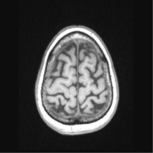 Cerebral arteriovenous malformation with hemorrhage (Radiopaedia 34422-35737 Axial T1 66).png