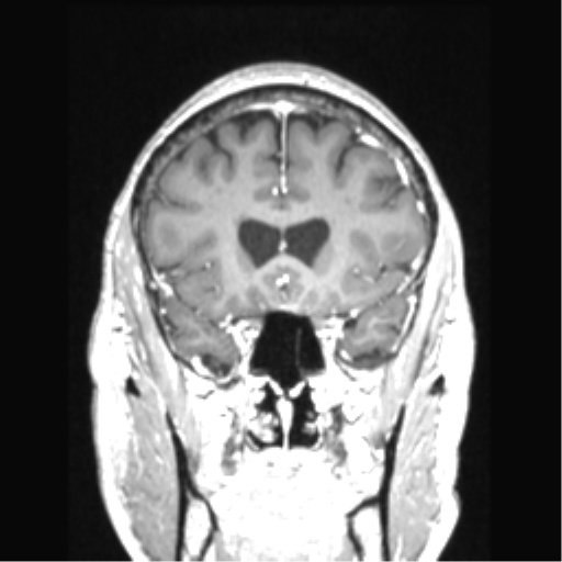 Cerebral arteriovenous malformation with hemorrhage (Radiopaedia 34422-35737 Coronal T1 C+ 64).png