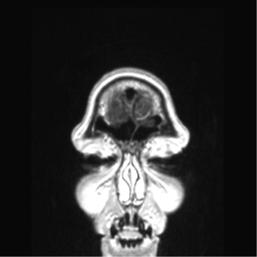 Cerebral arteriovenous malformation with hemorrhage (Radiopaedia 34422-35737 Coronal T1 C+ 88).png