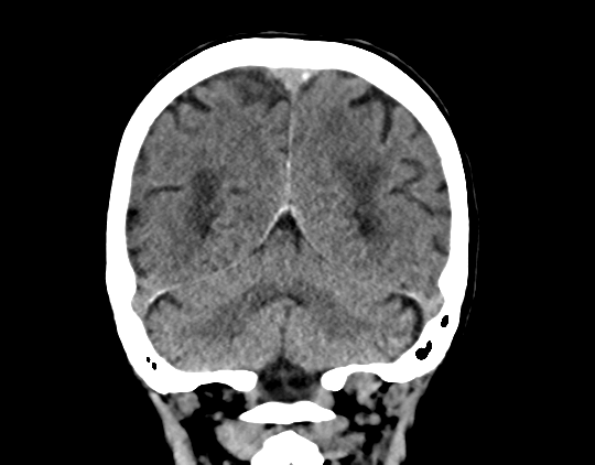 File:Cerebral arteriovenous malformation with lobar hemorrhage (Radiopaedia 44725-48510 Coronal non-contrast 36).png