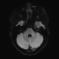 File:Cerebral cavernous venous malformation (Radiopaedia 70008-80021 Axial DWI 38).jpg