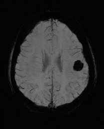 Cerebral cavernous venous malformation (Radiopaedia 70008-80021 Axial SWI 48).jpg