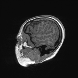 File:Cerebral cavernous venous malformation (Radiopaedia 70008-80021 Sagittal T1 11).jpg