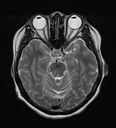 File:Cerebral cavernous venous malformations (Radiopaedia 48117-52946 Axial T2 9).png