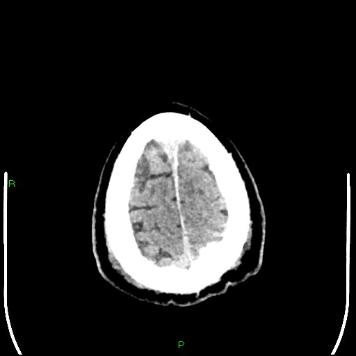 Cerebral contusions (Radiopaedia 33868-35039 Axial non-contrast 201).jpg