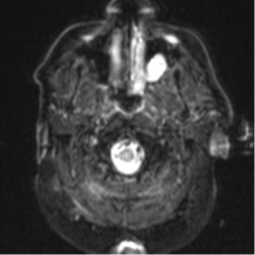 File:Cerebral embolic infarcts (embolic shower) (Radiopaedia 57395-64342 Axial DWI 2).png